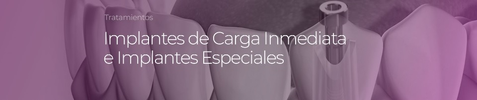 Implantes dentales